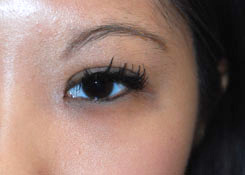 Eyelift Before & After Photo