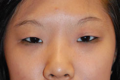 Eyelift Before & After Photo