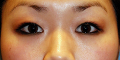 Eyelift Before & After Photo