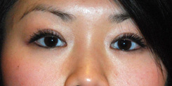 Eyelift Before & After Photo