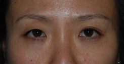 Eyelift Before & After Photo