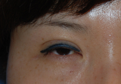 Eyelift Before & After Photo