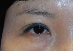 Eyelift Before & After Photo