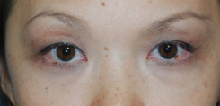 Eyelift Before & After Photo