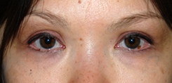 Eyelift Before & After Photo