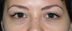 Eyelift Before & After Photo