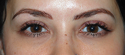 Eyelift Before & After Photo