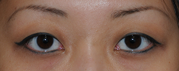 Eyelift Before & After Photo