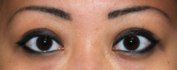 Eyelift Before & After Photo