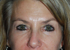 Eyelift Before & After Photo