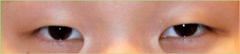 Eyelift Before & After Photo