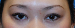 Eyelift Before & After Photo