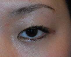 Eyelift Before & After Photo