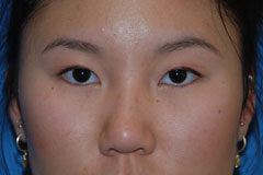 Eyelift Before & After Photo