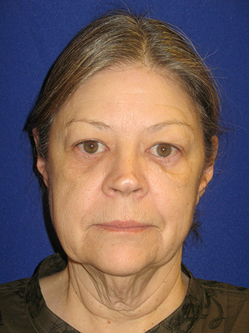 Facelift Before & After Photo