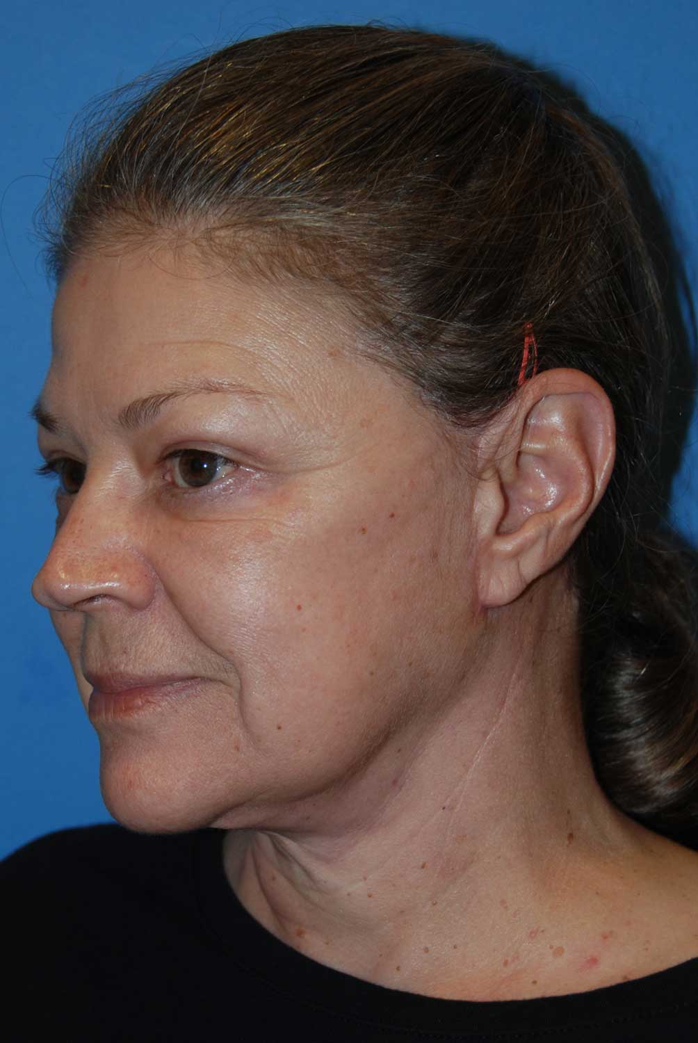 Facelift Before & After Photo