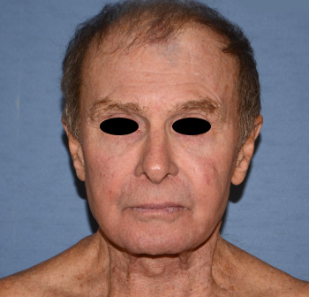 Facelift Before & After Photo