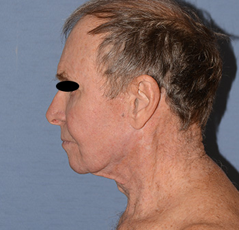 Facelift Before & After Photo