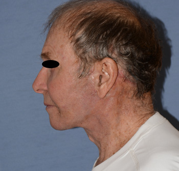 Facelift Before & After Photo