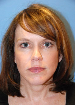 Facelift Before & After Photo