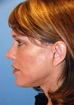 Facelift Before & After Photo