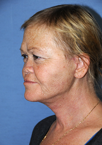 Facelift Before & After Photo