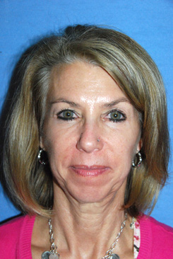 Facelift Before & After Photo