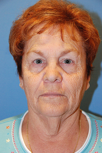 Facelift Before & After Photo