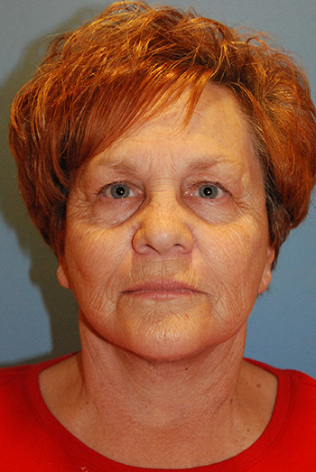 Facelift Before & After Photo