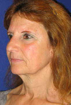 Facelift Before & After Photo