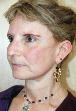 Facelift Before & After Photo