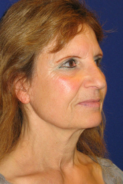 Facelift Before & After Photo