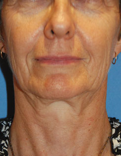 Facelift Before & After Photo