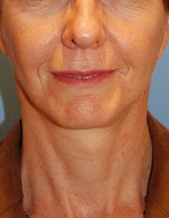 Facelift Before & After Photo