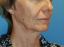 Facelift Before & After Photo