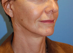 Facelift Before & After Photo