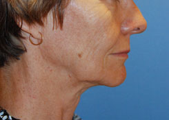 Facelift Before & After Photo