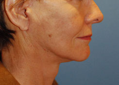 Facelift Before & After Photo