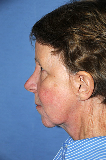 Facelift Before & After Photo