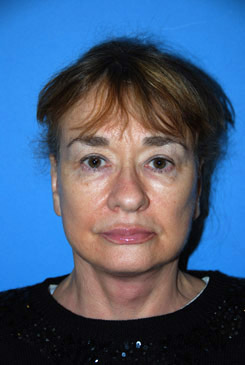 Facelift Before & After Photo