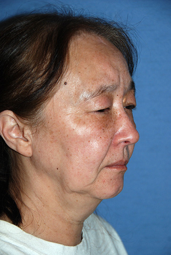 Facelift Before & After Photo