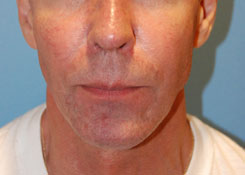 Jaw Implants Before & After Photo