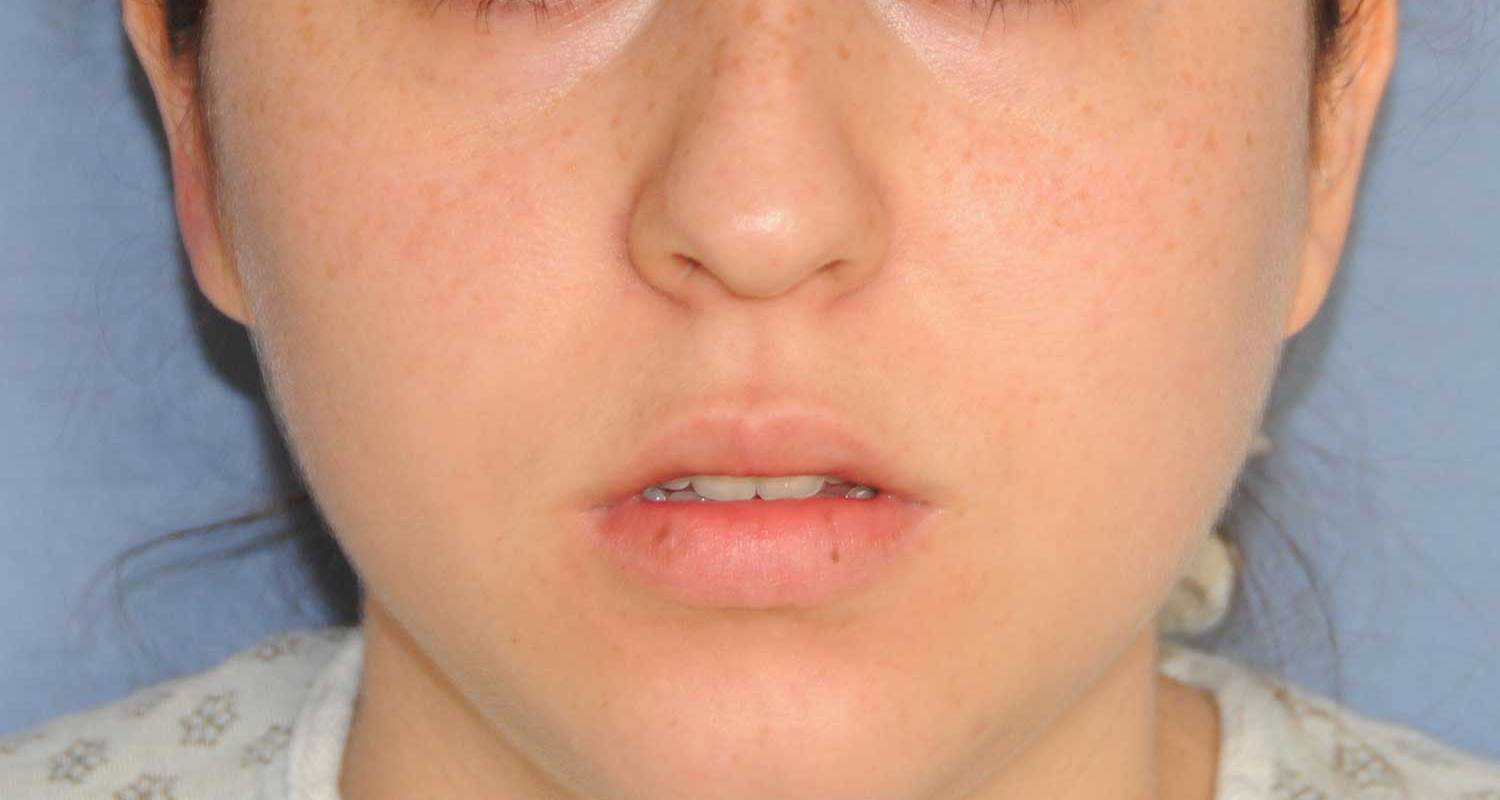 Lip Augmentation / Injection Before & After Photo