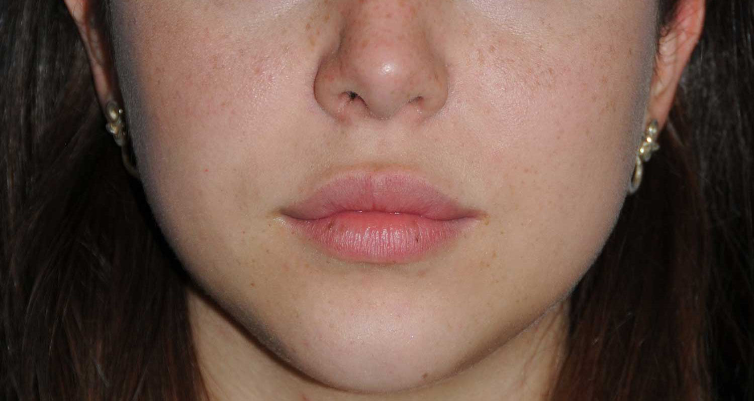 Lip Augmentation / Injection Before & After Photo