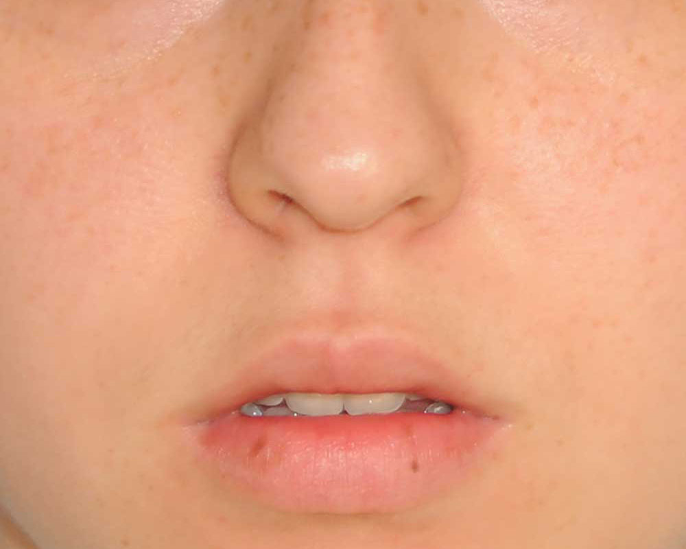 Lip Augmentation / Injection Before & After Photo