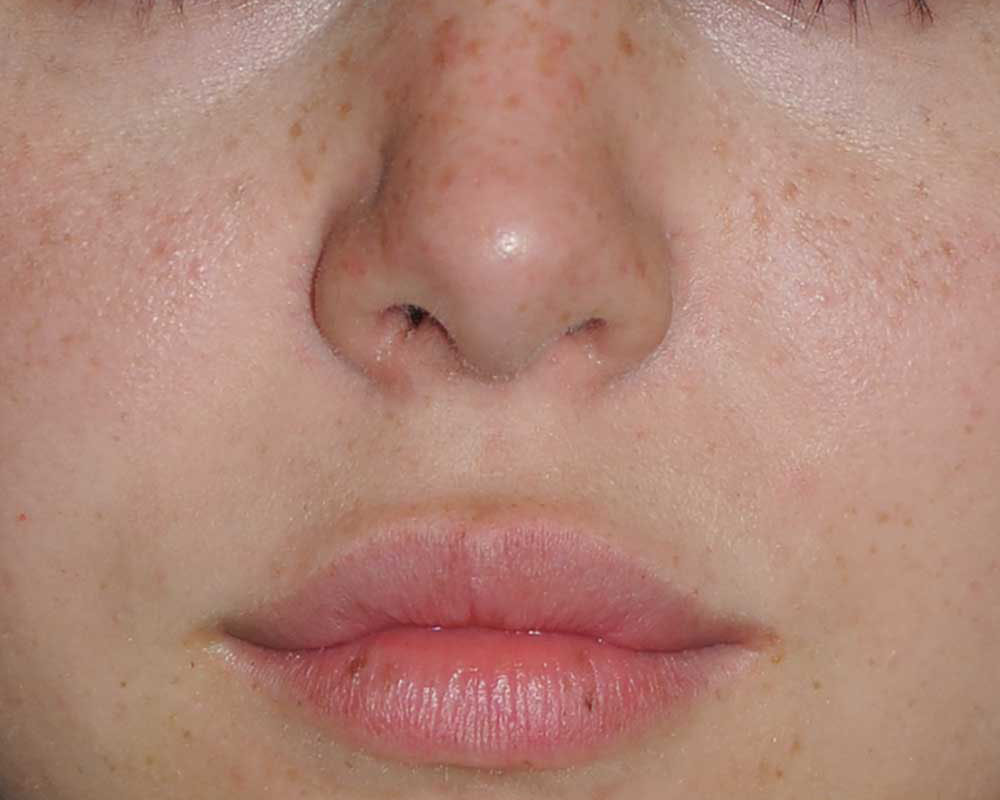 Lip Augmentation / Injection Before & After Photo