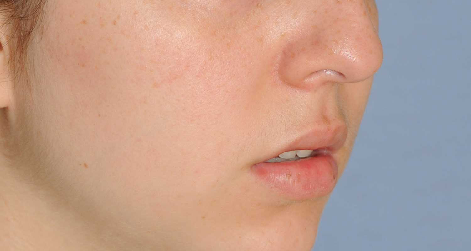 Lip Augmentation / Injection Before & After Photo