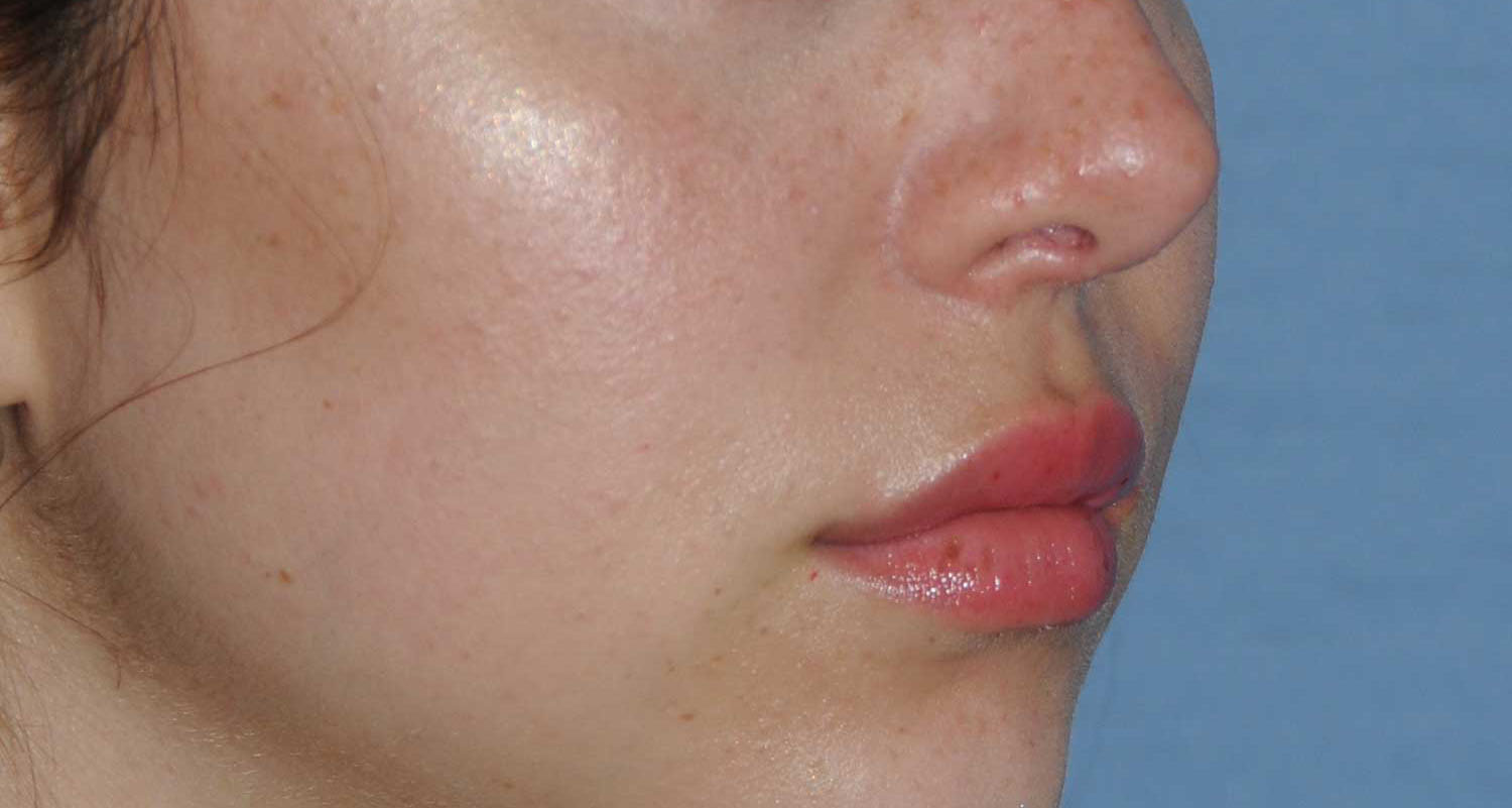 Lip Augmentation / Injection Before & After Photo