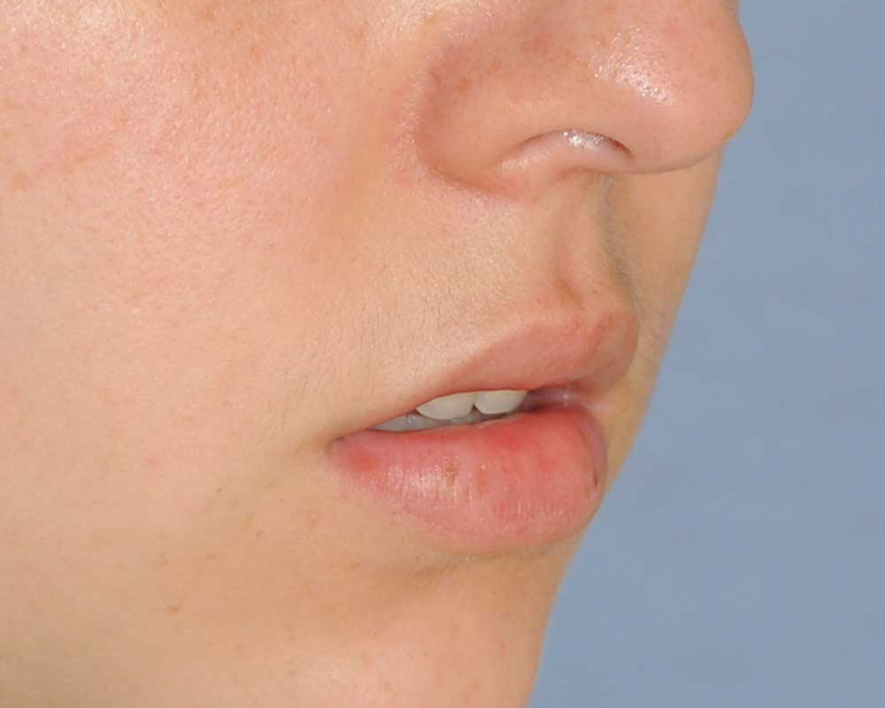 Lip Augmentation / Injection Before & After Photo