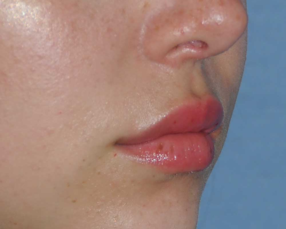 Lip Augmentation / Injection Before & After Photo